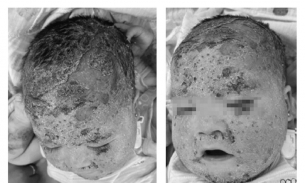 Tắm nhiều loại lá, bé trai 8 tháng tuổi nhập viện trong tình trạng nứt da đầu