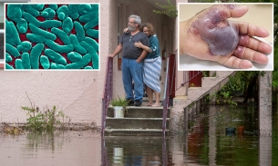 Vi khuẩn ‘ăn thịt người’ bùng phát ở Mỹ sau cơn bão Idalia
