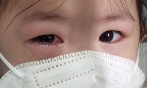 Sở Y tế TP HCM đã xác định được tác nhân gây bệnh đau mắt đỏ