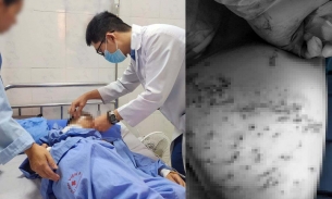 Thái Nguyên: Bé trai 11 tuổi nhập viện với chi chít vết thương do pháo nổ