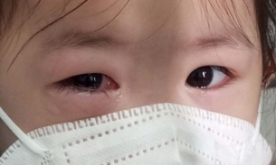 Bộ Y tế yêu cầu phát hiện sớm, xử lý kịp thời các ổ dịch bệnh đau mắt đỏ