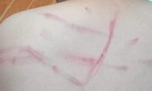 Thanh Hóa: Cô giáo đánh bầm tím lưng học sinh bị tạm đình chỉ