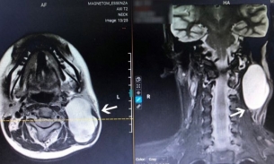 Cô gái đau như điện giật suốt 7 năm vì mang khối u ở cổ
