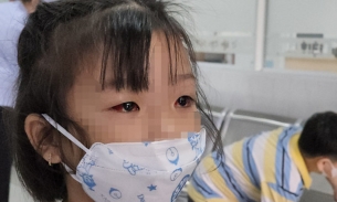 Hơn 2.200 trẻ dưới 16 tuổi ở TP HCM bị đau mắt đỏ chỉ trong một ngày