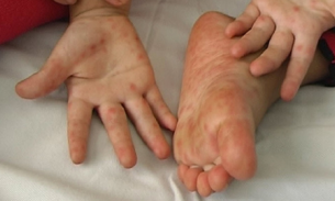 Đắk Lắk: Thêm 1 trường hợp tử vong do bệnh tay chân miệng