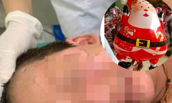 Bóng bay hình ông già Noel phát nổ khiến bé trai 4 tuổi bỏng toàn mặt