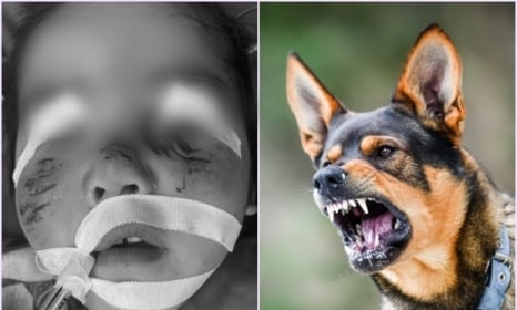 Phú Thọ: Bé 3 tuổi bị chó hàng xóm cắn lên mặt