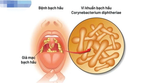 Bộ Y tế yêu cầu xử lý triệt để ổ dịch bạch hầu