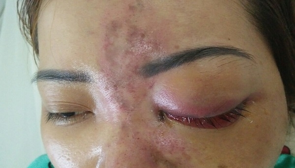 TPHCM: Nguy cơ mù mắt vì tiêm chất làm đầy (filler) tại spa