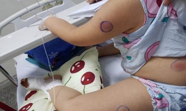 Bị gà mổ, bé gái 6 tuổi nhiễm vi khuẩn ăn thịt người