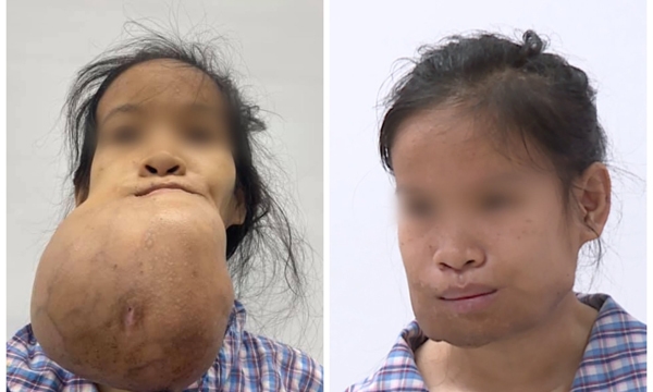 Phẫu thuật lấy khối u to như quả dừa ở mặt cô gái