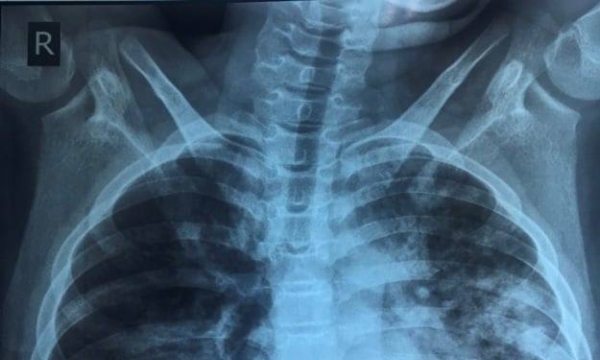 Điều trị thành công bé trai 13 tuổi mắc Covid-19 tổn thương phổi nặng