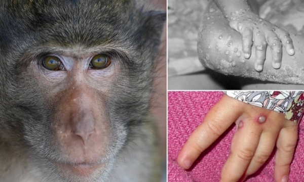 Bộ Y tế yêu cầu kiểm soát dịch kịp thời không để bùng phát dịch bệnh đậu mùa khỉ