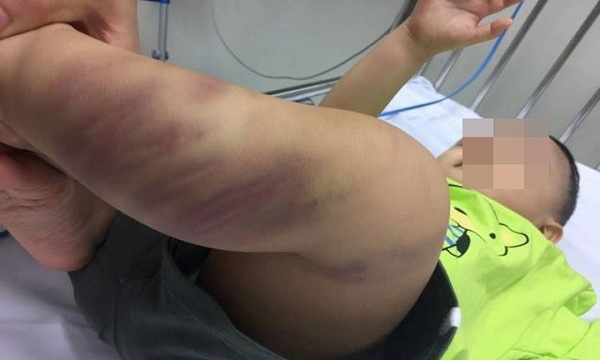 Hà Nội: Khởi tố vụ bé trai bị bạo hành dã man và bỏ lại bệnh viện