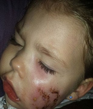 Bé gái 3 tuổi bị chó cắn nát 1 bên mặt