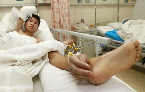 Bệnh nhân gắn tay vào chân trước khi phẫu thuật