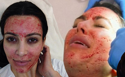 Kim Kardashian đau đớn vì bơm máu căng da mặt