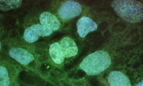 Tế bào gốc, niềm hy vọng cho bệnh nhân mắc  bệnh về gen