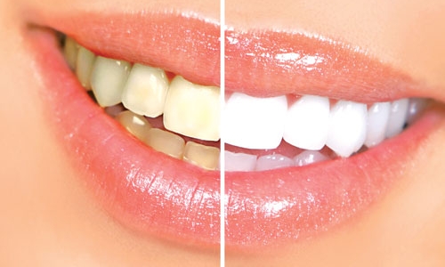 Tẩy trắng răng: Mối nguy hại khôn lường