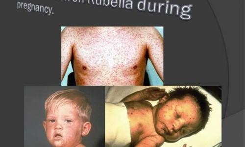 Rubella - Căn bệnh không thể xem nhẹ