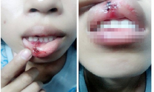 Công an Đồng Nai kết luận vụ cô gái bị 'người lạ' đánh rách môi