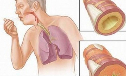 Biểu hiện lạ trong chữa ung thư phổi