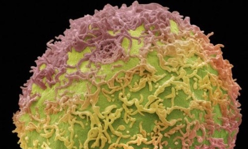 Liệu pháp 'gen tự sát' khiến tế bào ung thư tự hủy