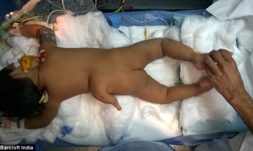 'Nhìn tận mắt' bé gái Ấn Độ sinh ra với 3 chân