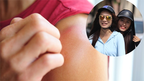 Phòng ngừa ung thư da: Áo chống tia UV lên ngôi
