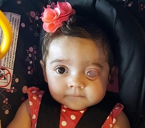 10.000 trẻ thì xuất hiện một em bé có mắt như thế này