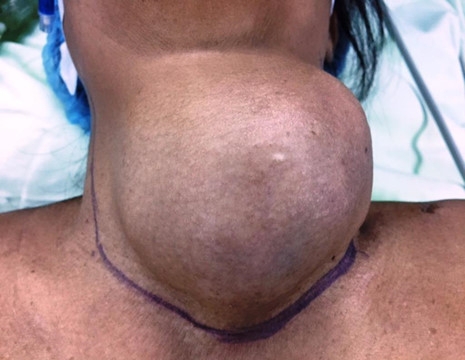 Đà Nẵng: Phẫu thuật thành công bệnh nhân mang khối u nặng 1,2 kg