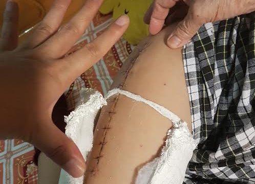 Học sinh bị gãy xương đùi đã trở lại học tập sau 3 tháng chữa trị