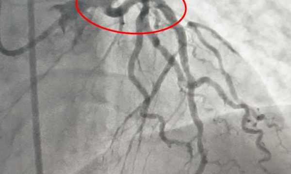 Báo động đỏ liên viện: Đặt stent động mạch vành bị tắt nghẽn cứu sống bệnh nhân nguy kịch