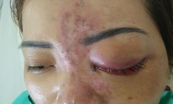 TPHCM: Nguy cơ mù mắt vì tiêm chất làm đầy (filler) tại spa