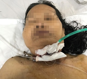 Quảng Nam: Cứu sống một bệnh nhân bị đứt khí quản