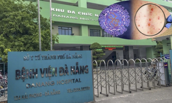 Bệnh nhân nghi mắc đậu mùa khỉ ở Đà Nẵng có xét nghiệm âm tính