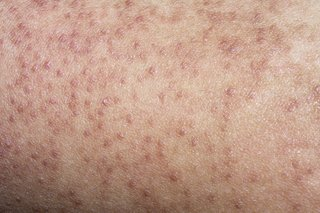 Viêm nang lông có thể gây ra vấn đề về da như thâm, sưng, hoặc viêm không?
