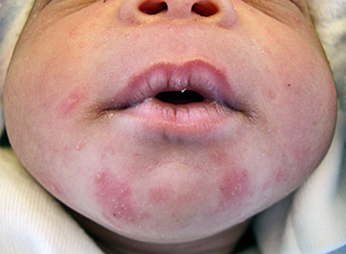 Mụn mủ ở bé sơ sinh có thể xuất hiện ở mọi vùng da hay chỉ ở những vùng đặc biệt?
