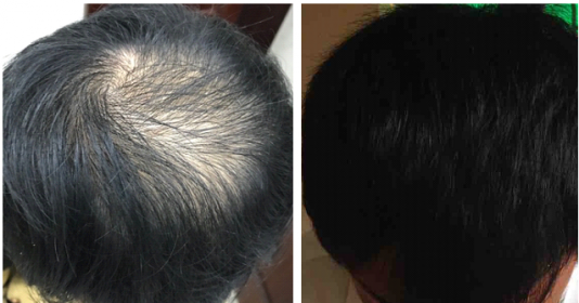 Bài thuốc đơn giản giúp tóc rụng mọc lại sau chỉ sau 2 tháng