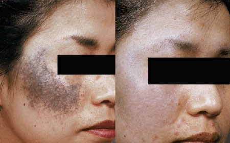 Có phương pháp điều trị nào cho nevus ota không?
