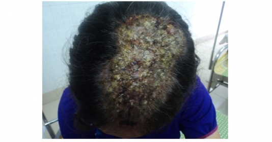 Phương pháp điều trị hiệu quả nhất cho nấm da đầu có mủ?
