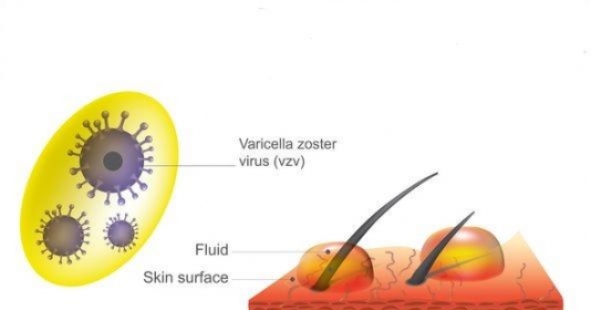 Virus Varicella Zoster gây bệnh zona và bệnh thủy đậu có liên quan gì tới nhau?
