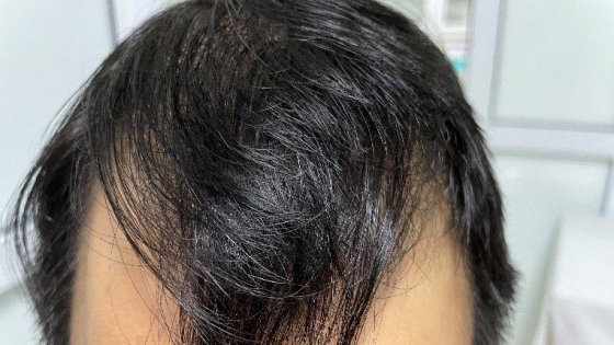 Rụng tóc ở giai đoạn ngừng phát triển của tóc (TE)