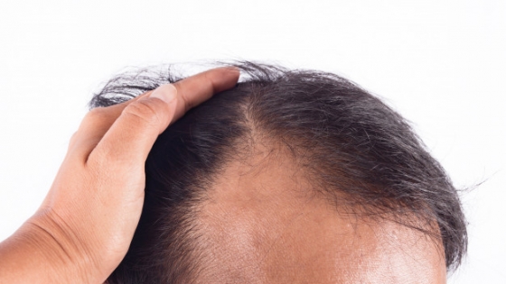 6 cách trị rụng tóc dành cho nam giới hiệu quả