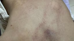 Chủ tịch phường Bồ Đề nói sẽ 'xử lý nghiêm' vụ bé gái 4 tuổi nghi bị cô giáo bạo hành tím lưng ở Hà Nội