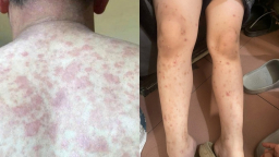 Nhiều người da ngứa rát, nổi mụn mủ sau khi bơi: Bác sĩ chỉ 'thủ phạm' lây nhiễm chéo đặc biệt vào ngày hè