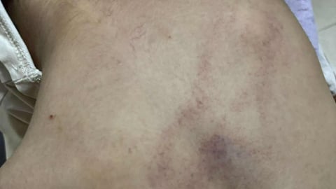 Chủ tịch phường Bồ Đề nói sẽ 'xử lý nghiêm' vụ bé gái 4 tuổi nghi bị cô giáo bạo hành tím lưng ở Hà Nội