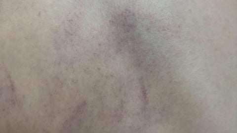 Vụ bé gái 4 tuổi ở Hà Nội bị cô giáo đánh tím lưng: Giáo viên thừa nhận đánh cháu bé