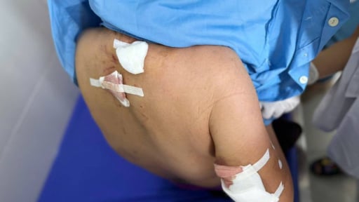 Kinh hoàng cụ bà 77 tuổi bị chó cắn với nhiều vết thương trên cơ thể
