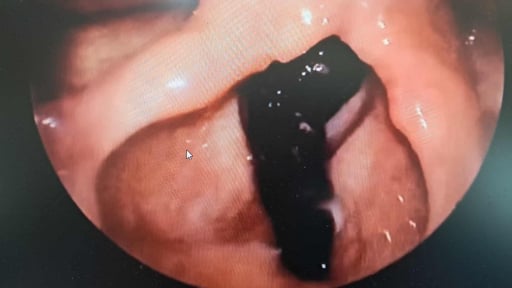 Kinh hãi 'thủ phạm' khiến bé 3 tuổi ho từng cơn, khạc ra máu